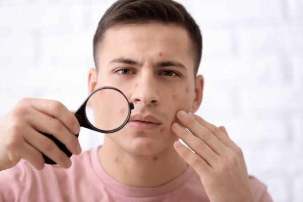 Acné: La rutina ideal y completa para combatirlo